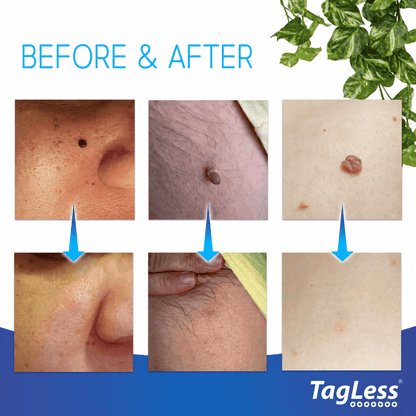 Auto Tagless Skin Tag Removal Kit